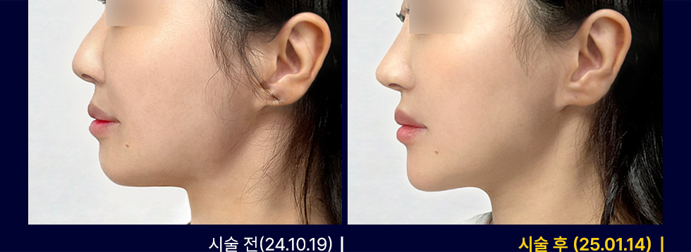 전후사진
