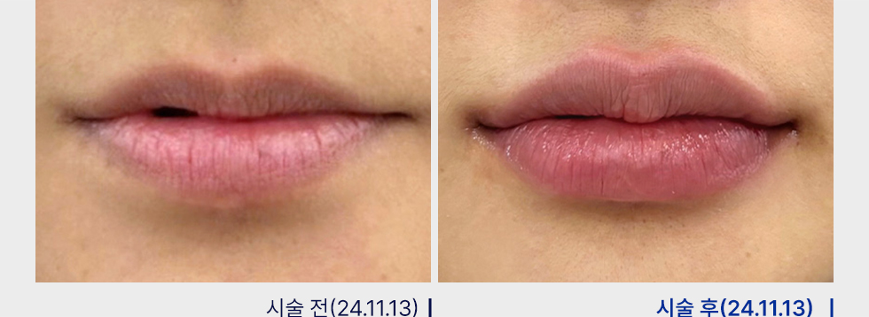 전후사진