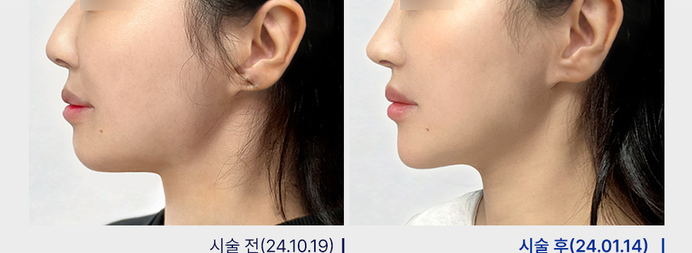 전후사진