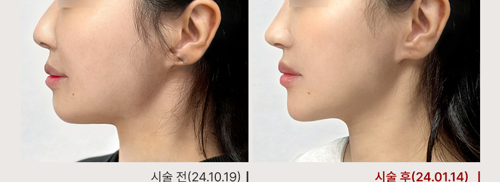 전후사진