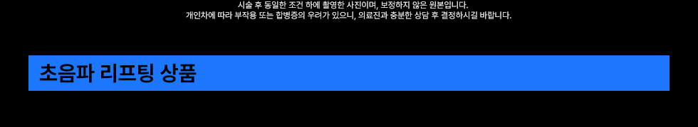 초음파 리프팅 상품