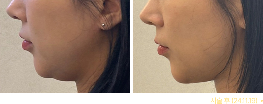전후사진