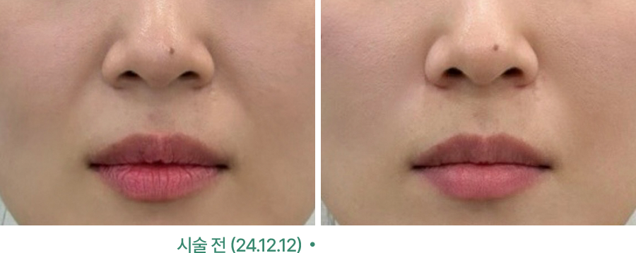 전후사진