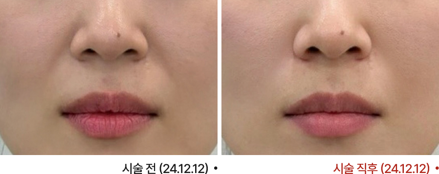 전후사진