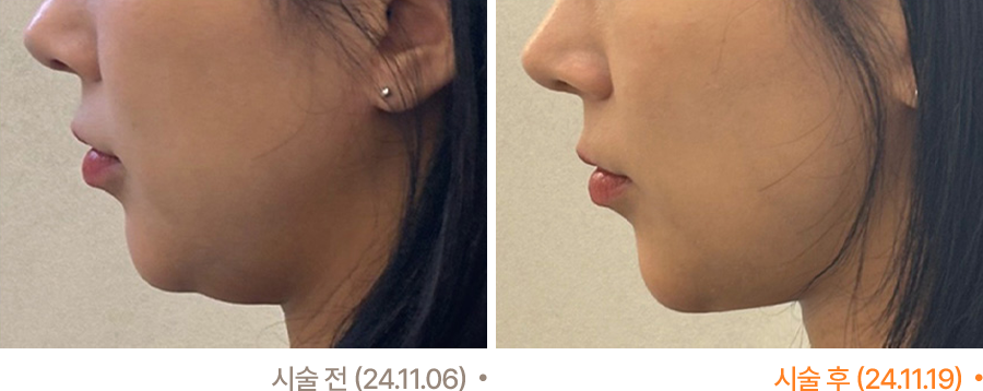 전후사진
