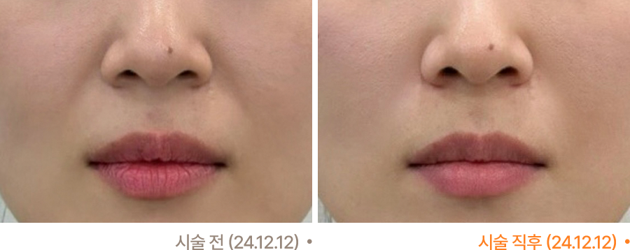 전후사진