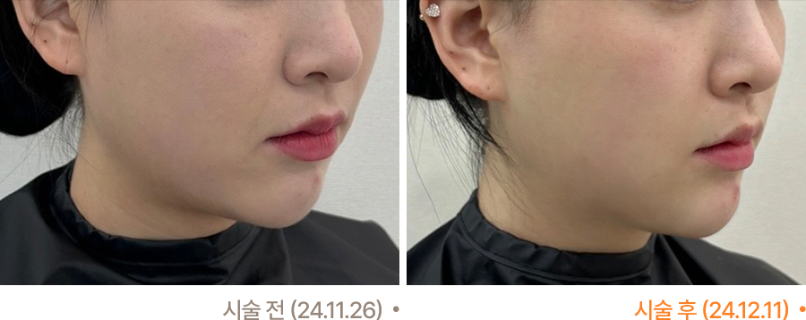 전후사진